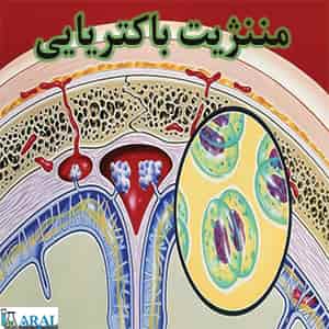 مننژیت باکتریایی یکی از بیماری های شایع باکتریایی است